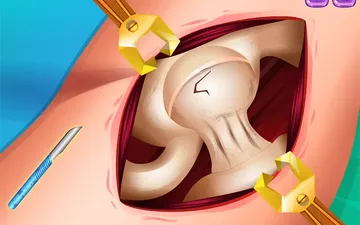 Princess Hips Surgery